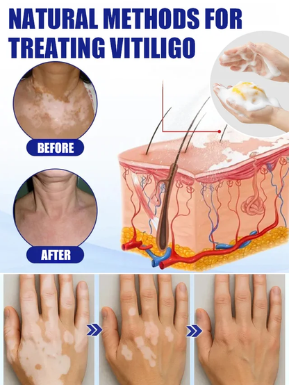 Angel Miracle White Spot Removal Soap